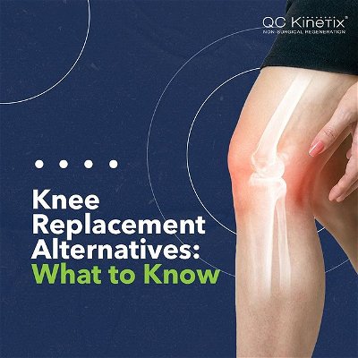 It is very difficult living with chronic knee pain — we get it.

If your provider has examined you, done some imaging, and sees that arthritis is causing your knee pain, it may be suggested that you have partial or total knee replacement surgery.

Click the link in our bio to read our blog to learn more about knee replacement alternatives to surgery! 💻🩺

#QCKinetix #EmmittSmith #regenerativemedicine #tissueengineering #healthcare #health #science #medicine #aging #wellness #neuroscience #nanotechnology #sciencenews #regenerative #paralysis #medicalresearch #chronicpain #stemcelltreatment #kneepain #backpain #osteoarthritis #arthritis #jointpain #pain #health #knee #running #rehab #painrelief #exercise