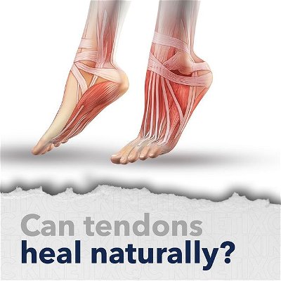 You probably never even think about the job being done by the tendons in your body until you’ve had an injury and experience some level of pain. Question is, can tendons heal naturally after an injury, or will you have to seek treatment? 

In our blog, "Can Tendons Heal Naturally? 4 Myths and Truths," we unpack the myths and truths about how tendons heal. Link in bio to read! 💻🏃‍♀️