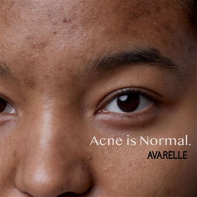 You is kind.
You is smart.
You is important.

Today's #AcnePositivityDay, why don't we take a little step back and accept who we are, just the way we are, at least for today? 😉

---
#avarelle #hydrocolloid #hydrocolloidpatches #hydrocolloidpatch #acnepatch #acnepatches #acne #acnetreatment #skincare #skin #acneskincare #acneskin #acneawarenessmonth #acneawareness #avarellecosmetics #acneskincareroutine #acnejourney #acnepositivity #acnepositivityday