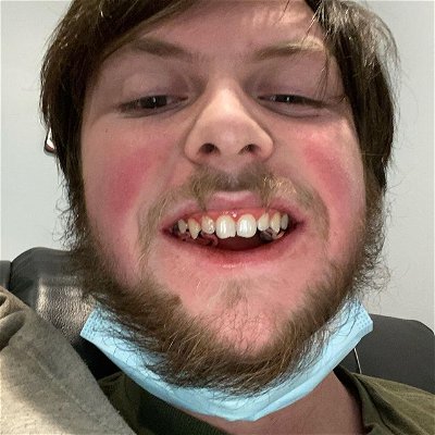 Well the wisdom teeth came out today and the pain scale is through the roof it’s actual garbage how bad it fuckin hurts