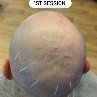 This Is A Process, I Like To Post These 1st Session Clips To Give You Guys As Much Info About Hair Tattoos Before You Get In The Chair👍

On A First Session We Design The Hairline & Lay The Foundations To Build Density On The 2nd Session.👷